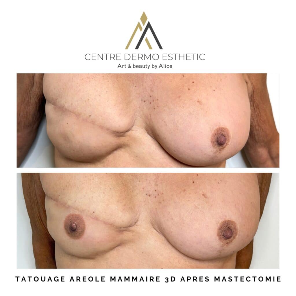 Tatouage aréole mammaire 3D photo après mastectomie.