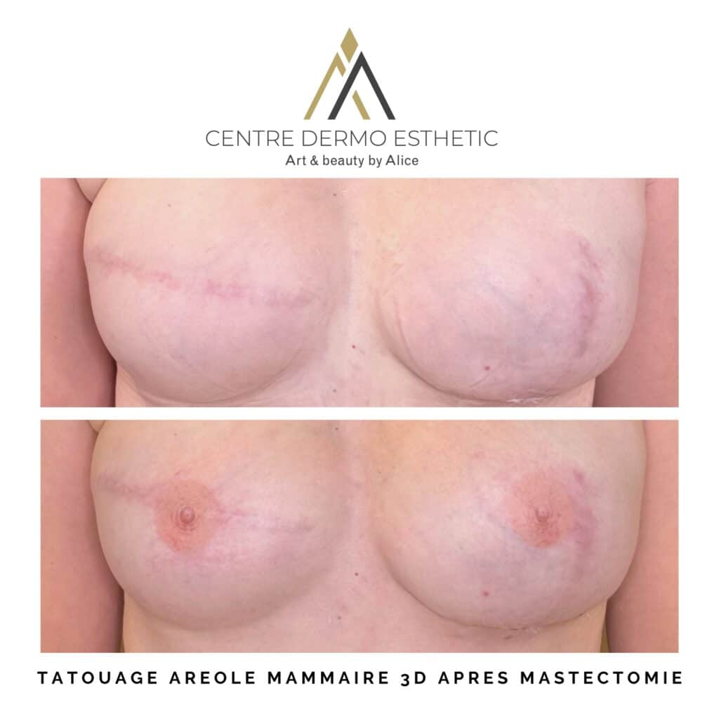 Photo de tatouage des 2 aréoles mammaires suite à mastectomie
